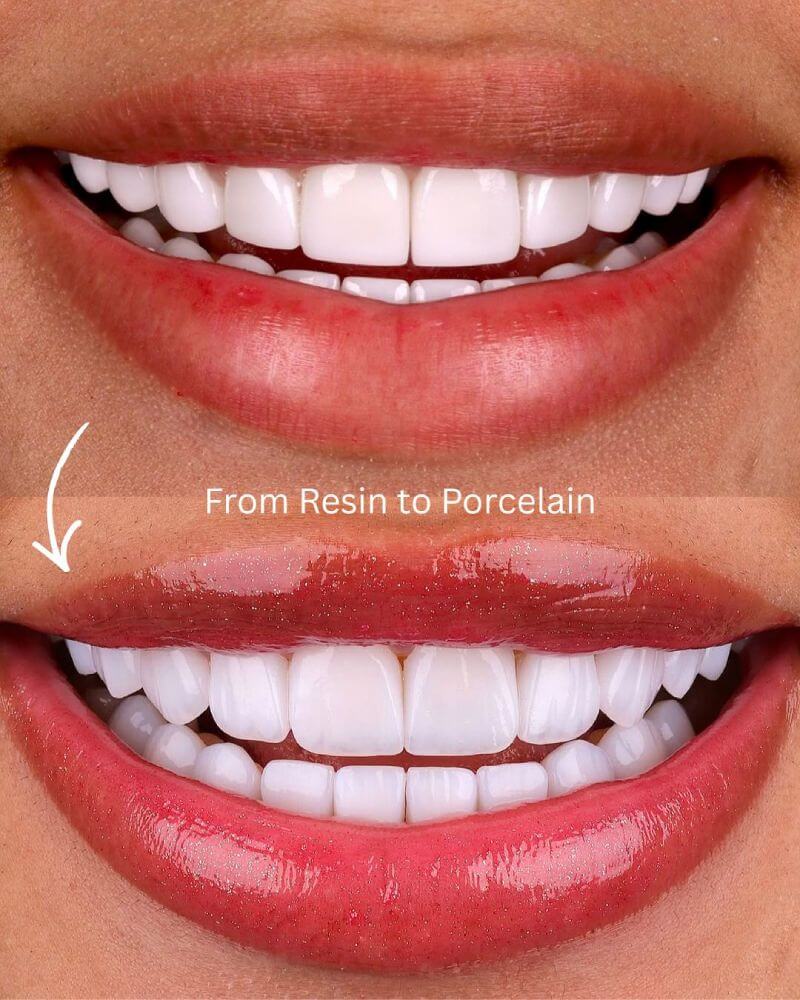 Before and after porcelain veneers in Miami