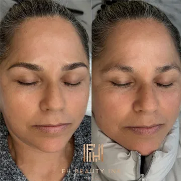 Before and after microblading results showing natural everyday brows by FH Beauty Ink Burbank after successful allergy testing