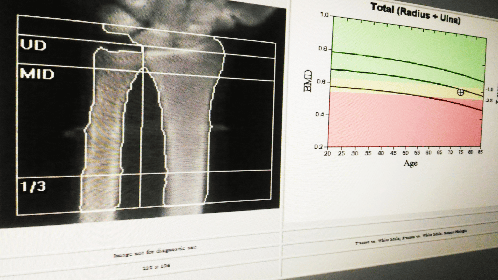 Bone density analysis