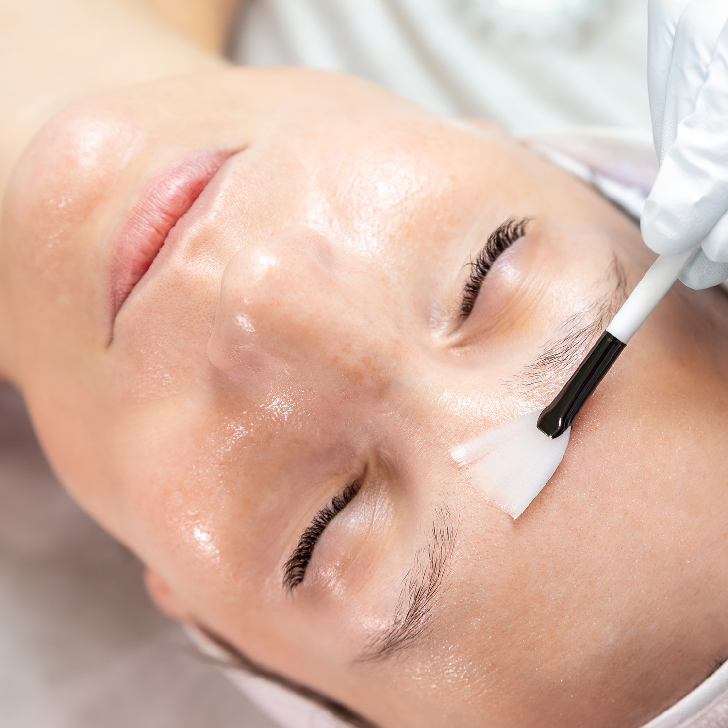 Chemical Peels