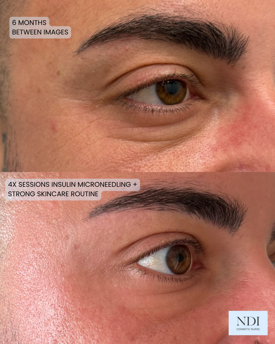 Crow's feet and skin quality before and after
