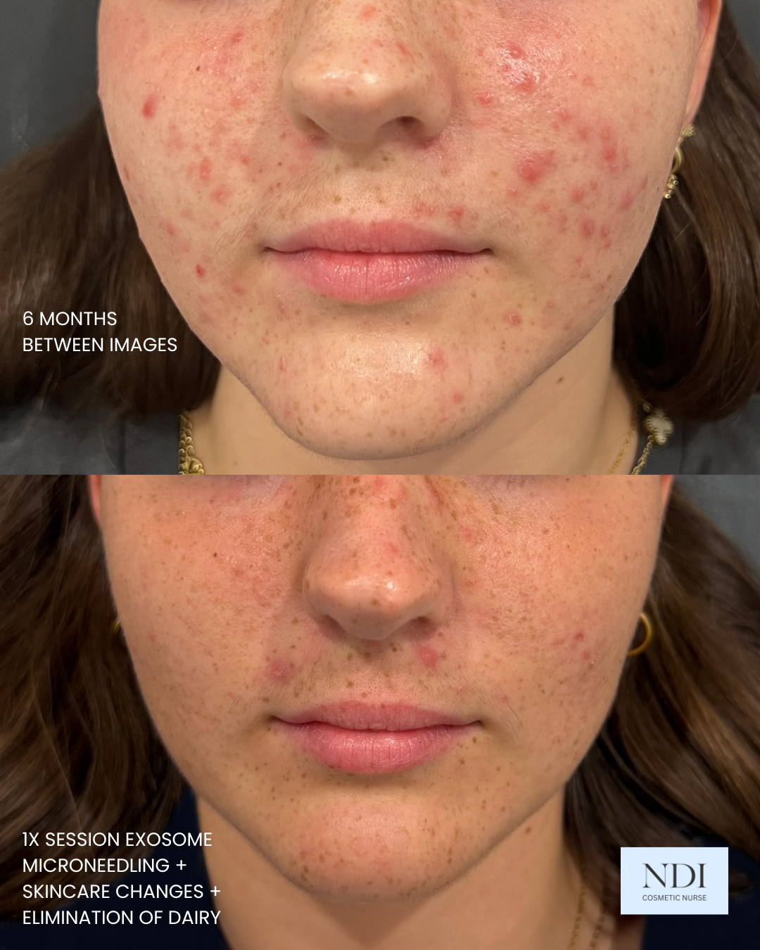 Acne before and after