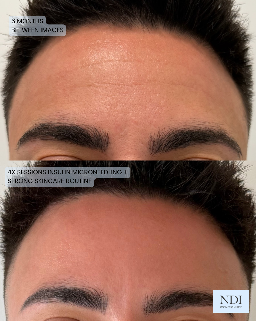 Forehead lines before Growth Factor Microneedling