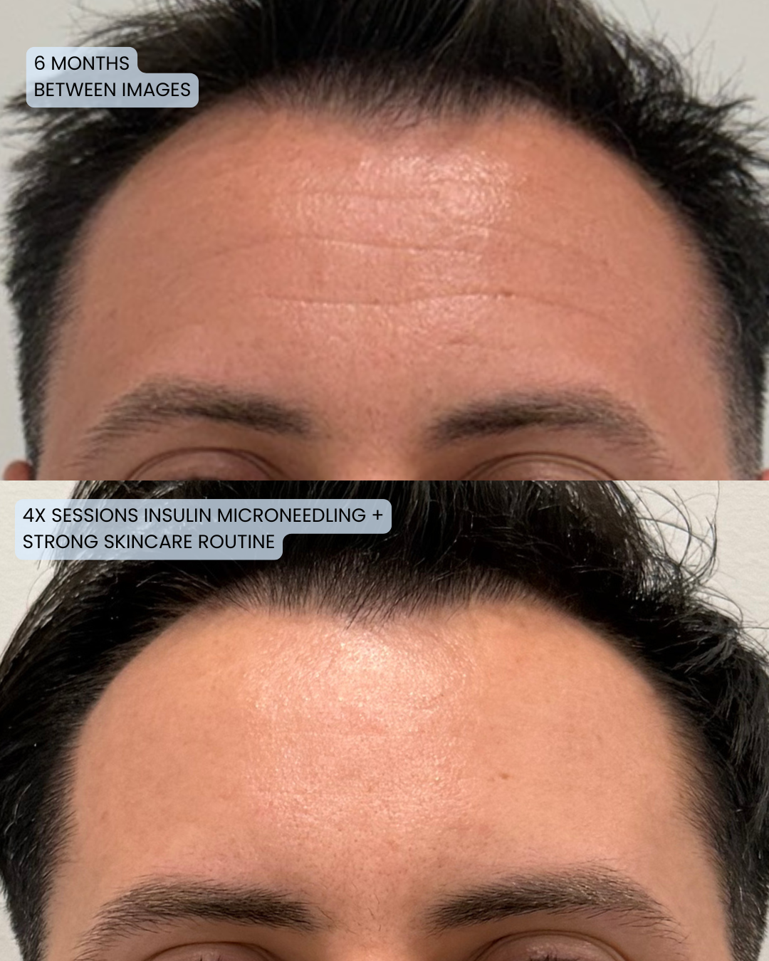 Forehead lines before and after