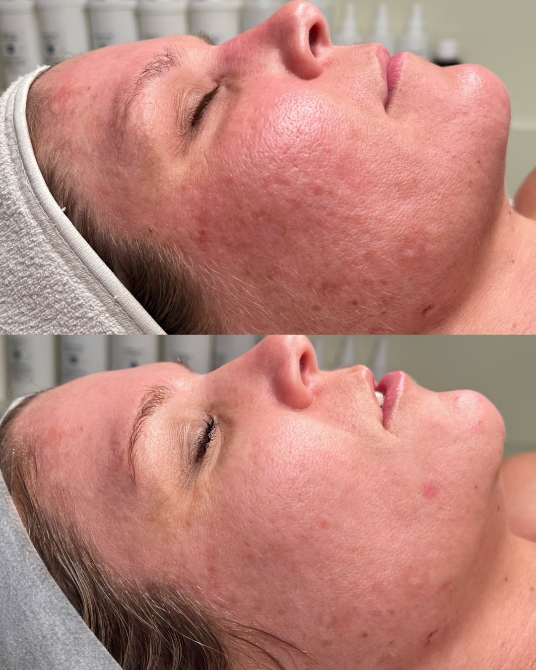Double Cleanse client before and after, skin journey 2