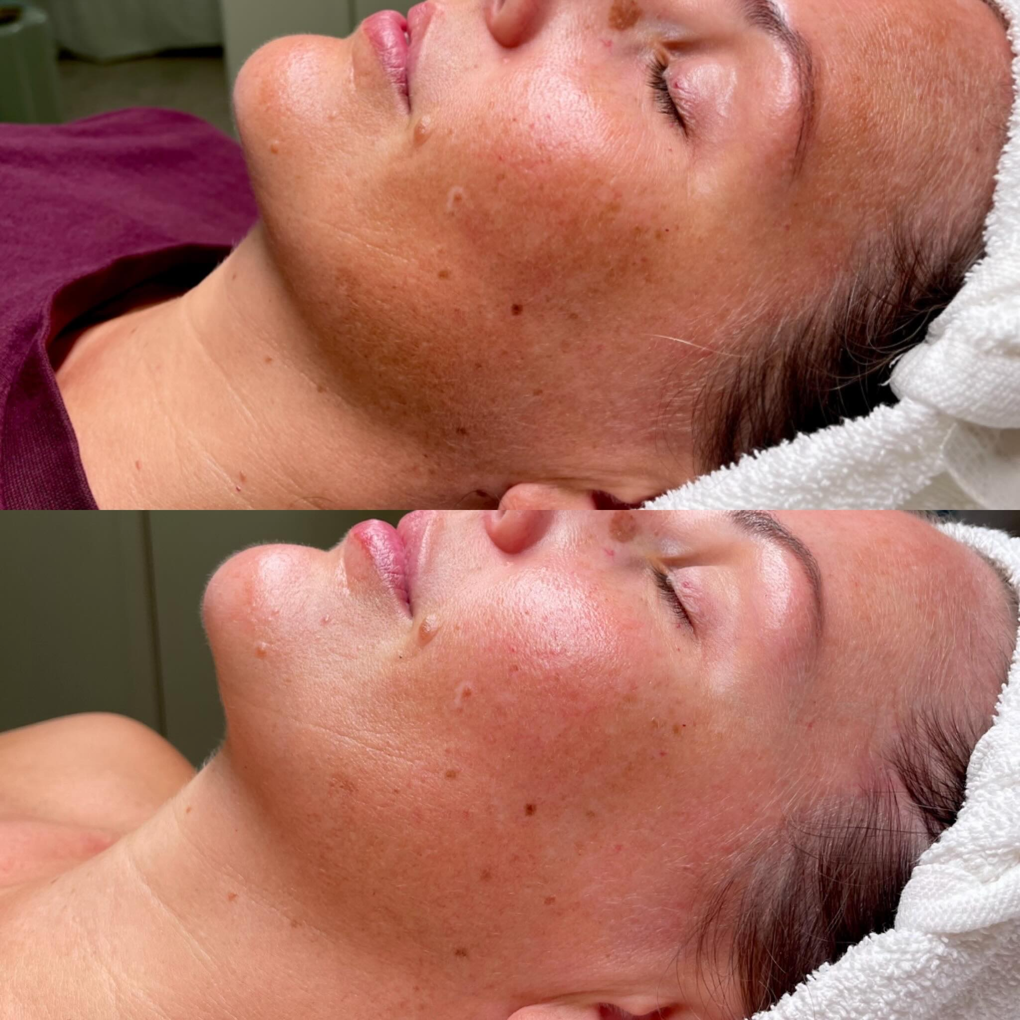 Double Cleanse client before and after, skin journey 1