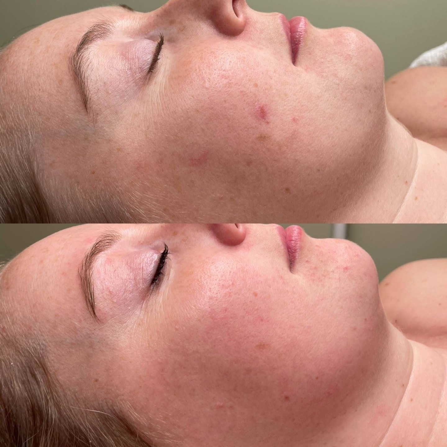 Double Cleanse client before and after, skin journey 5