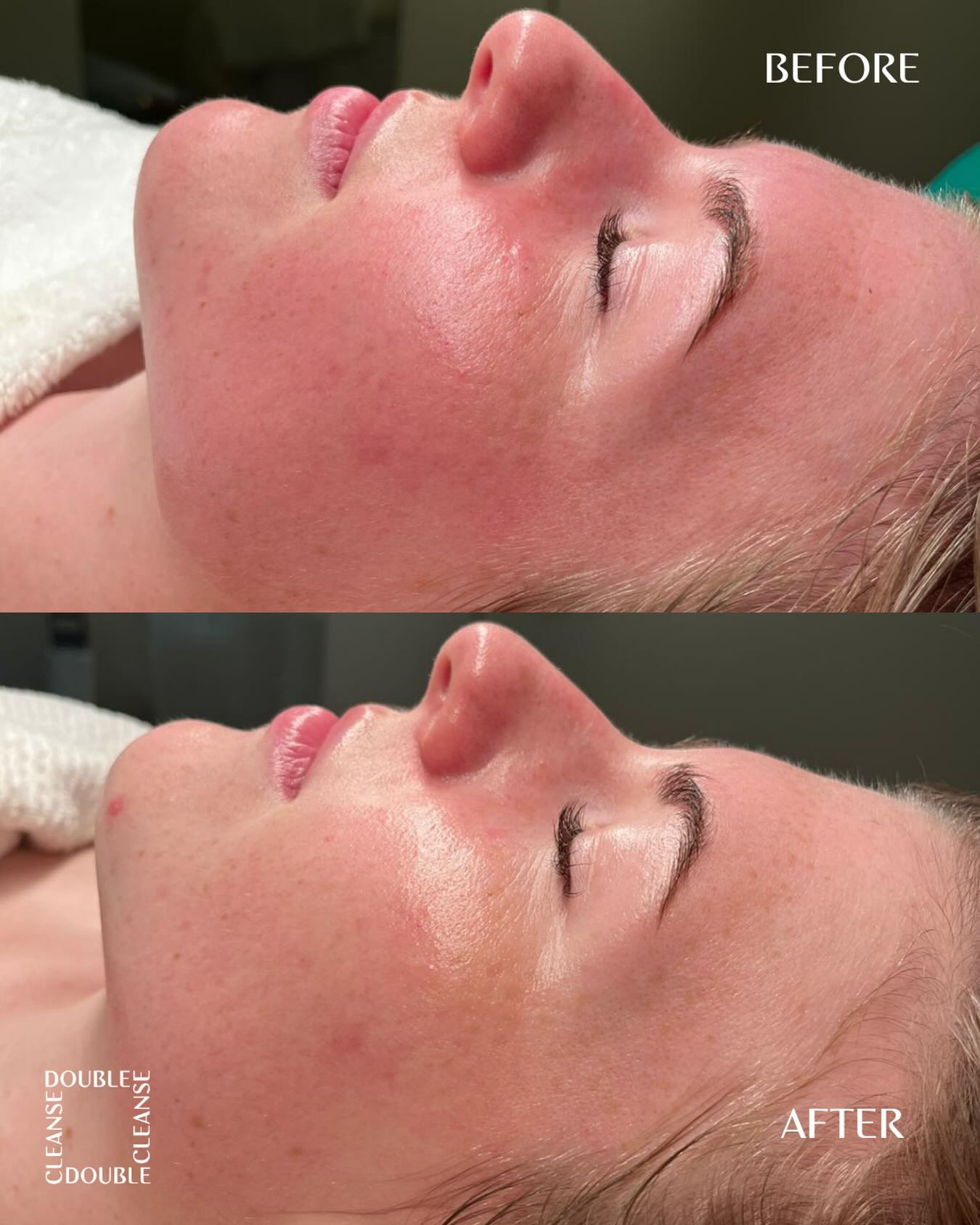 Double Cleanse client before and after, skin journey 6