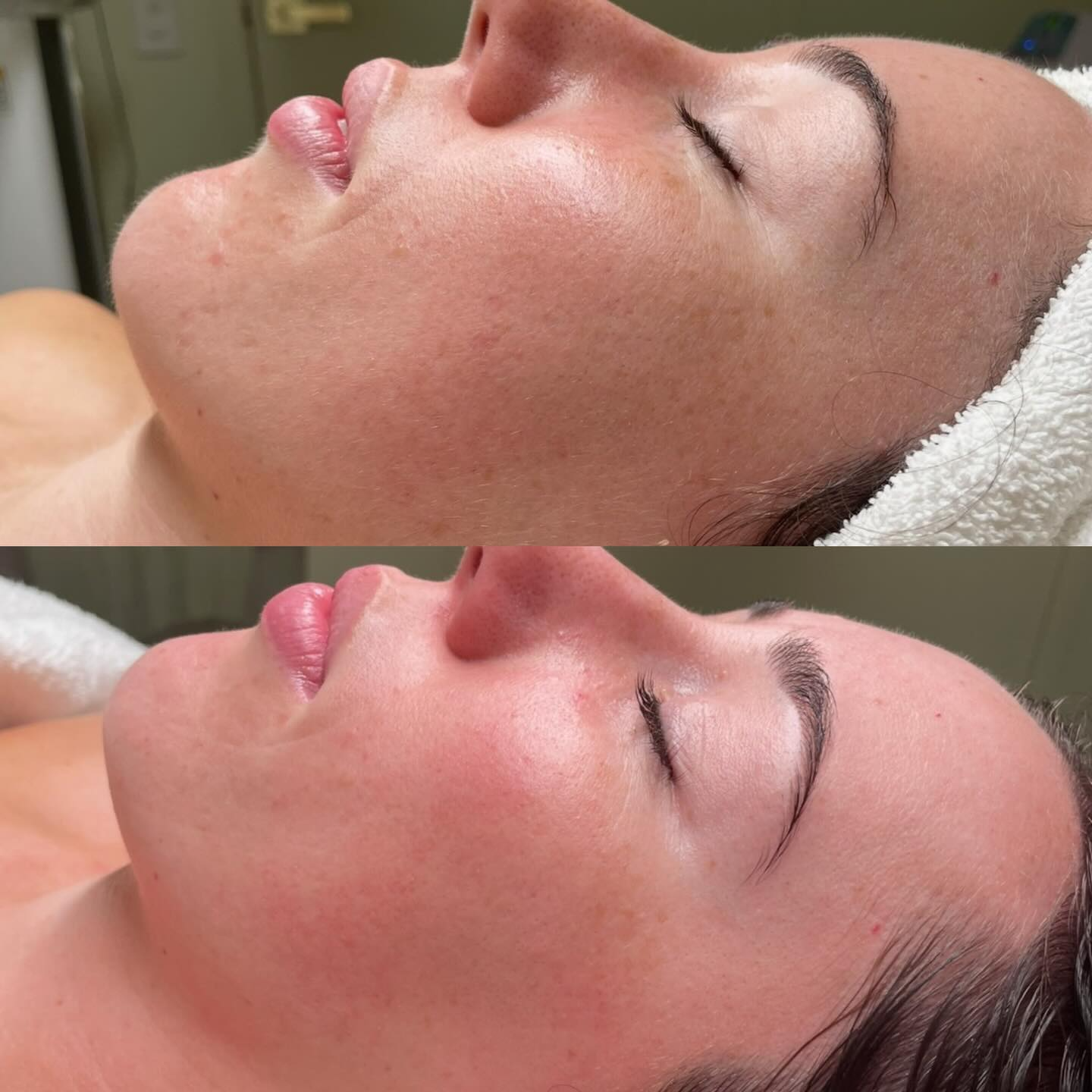 Double Cleanse client before and after, skin journey 3