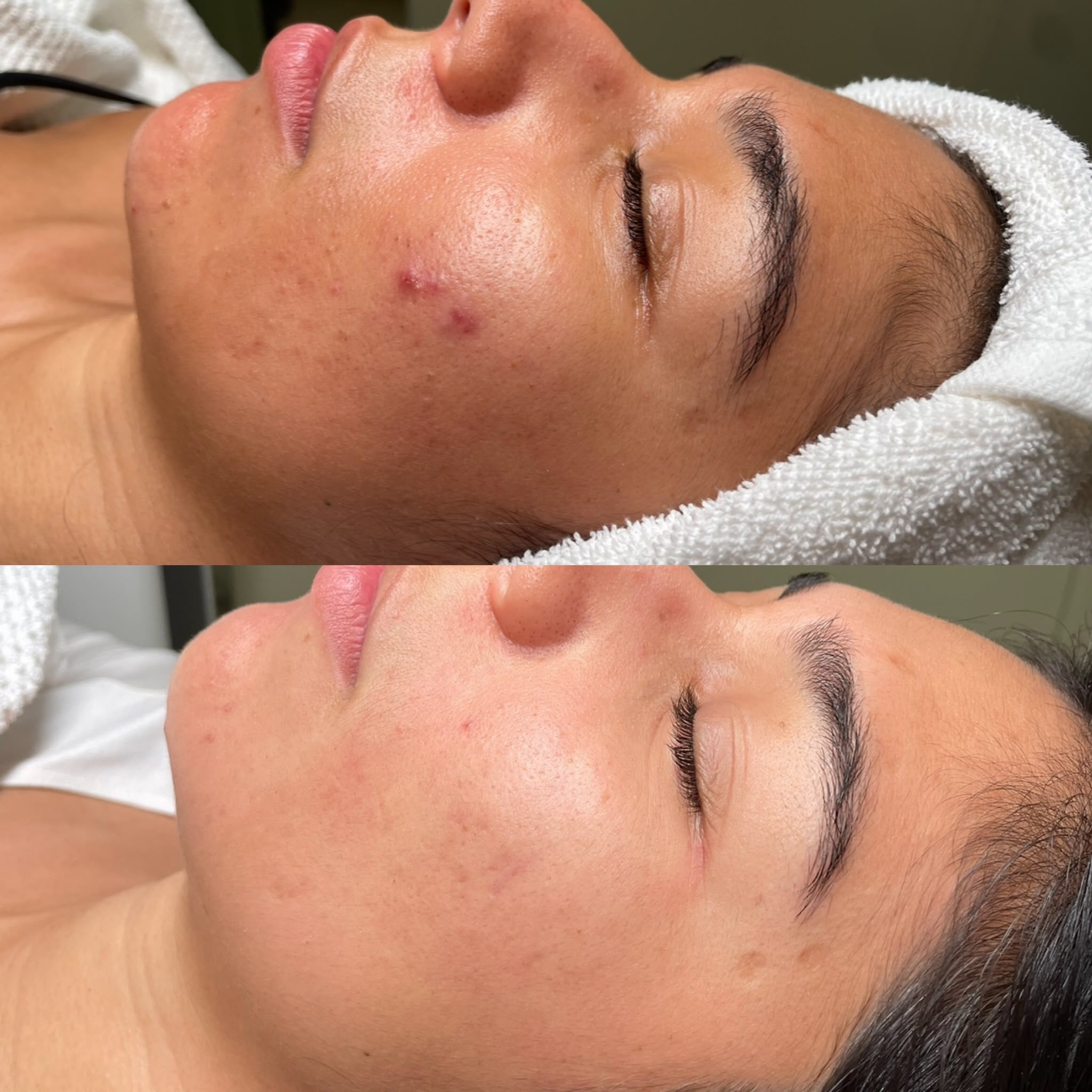 Double Cleanse client before and after, skin journey 4