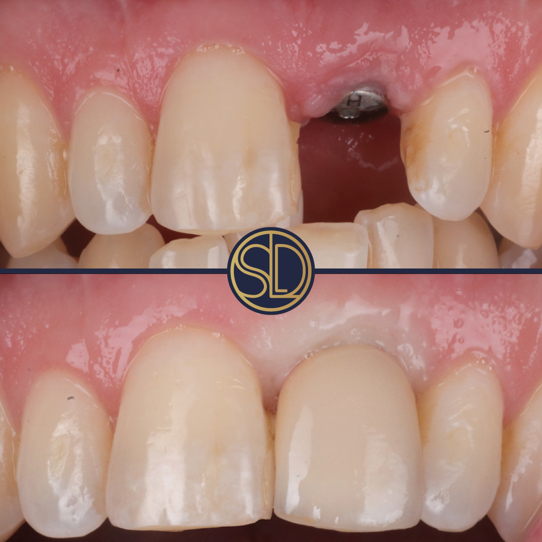 Single-tooth implant: before above, after below