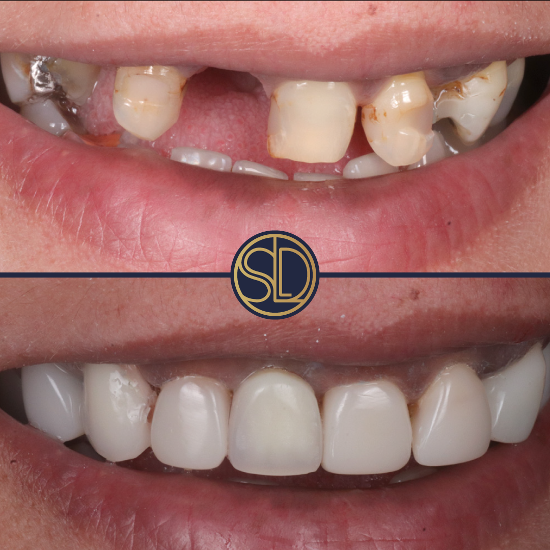 Composite bonding and dentures: before above, after below