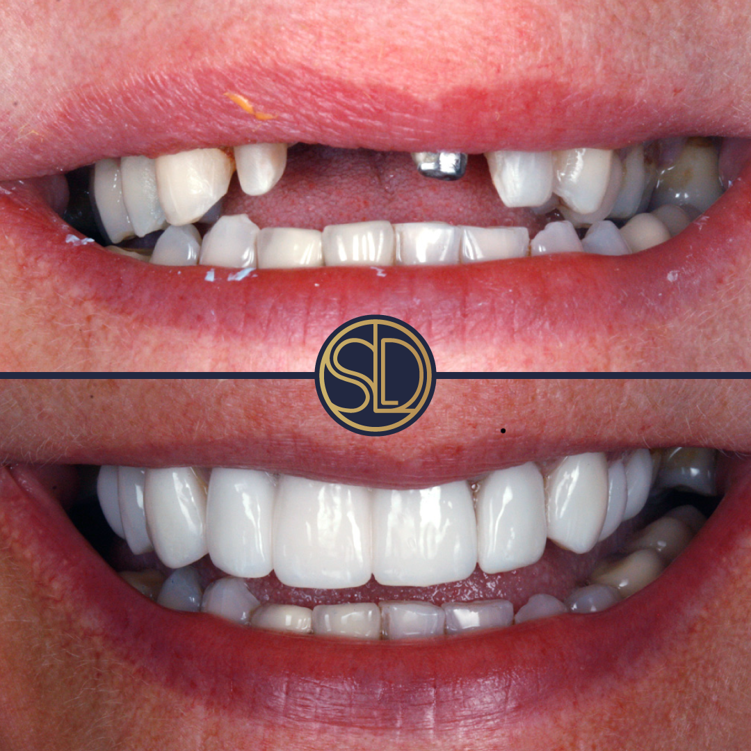 Bridge and porcelain veneers: before above, after below