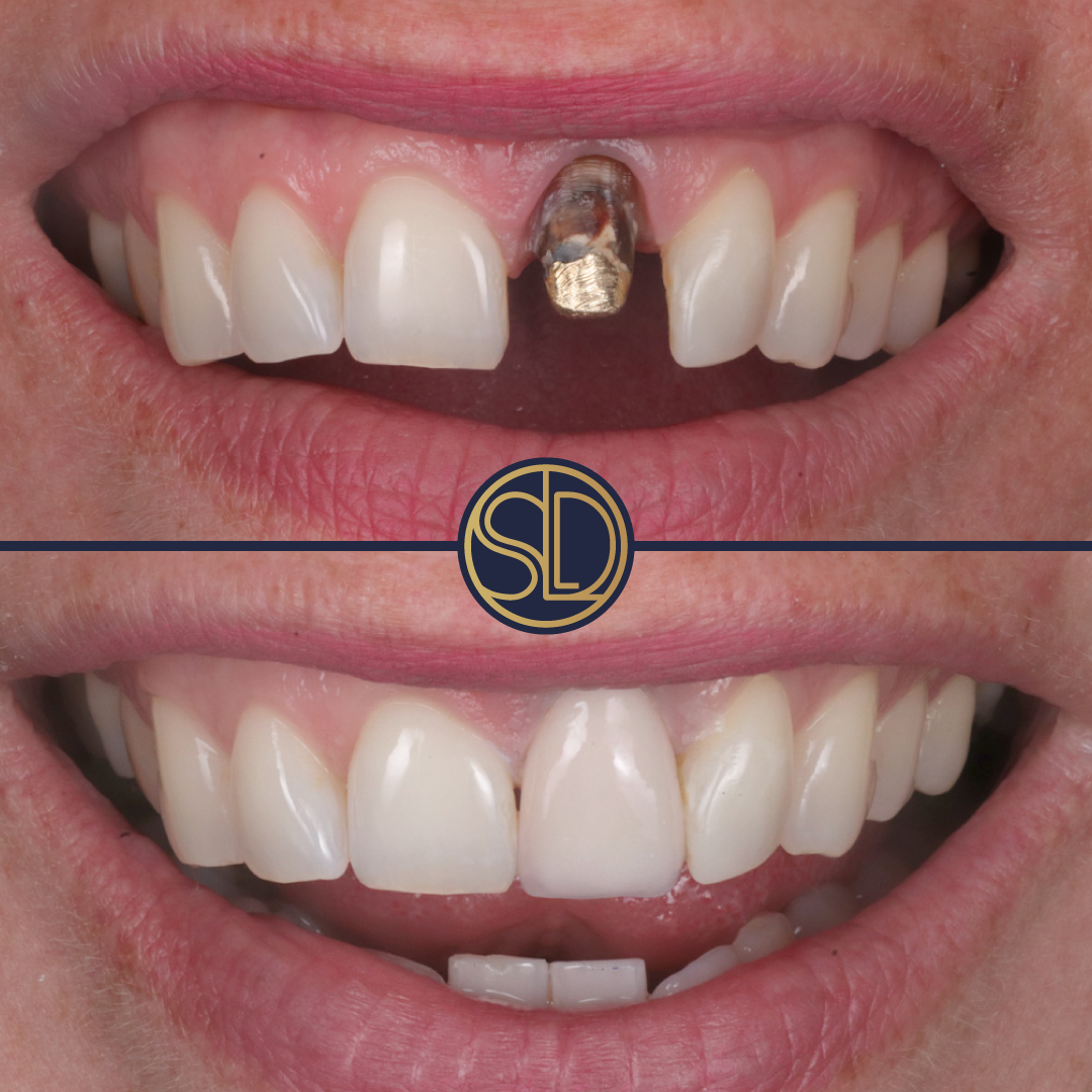 Central incisor crown: before above, after below
