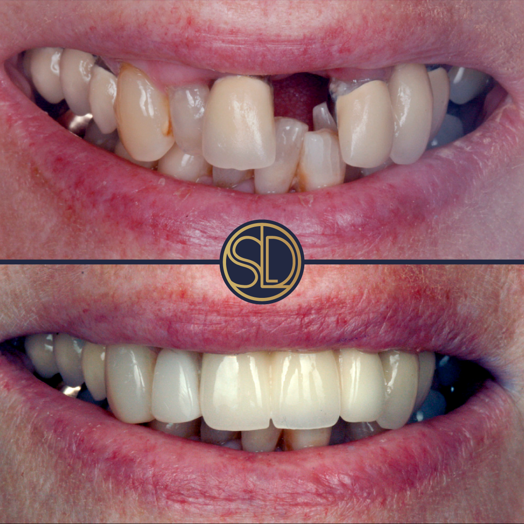 Upper front-tooth bridge: before above, after below