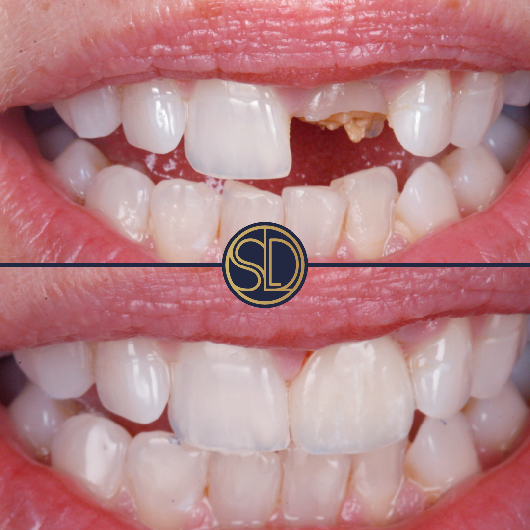 Incisor crown: before above, after below