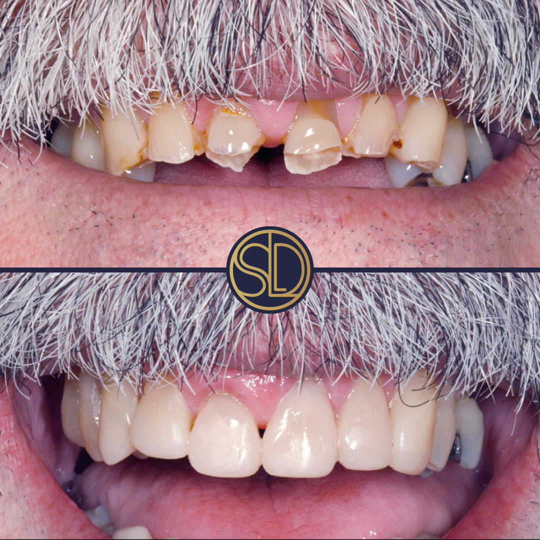 Composite repair: before above, after below
