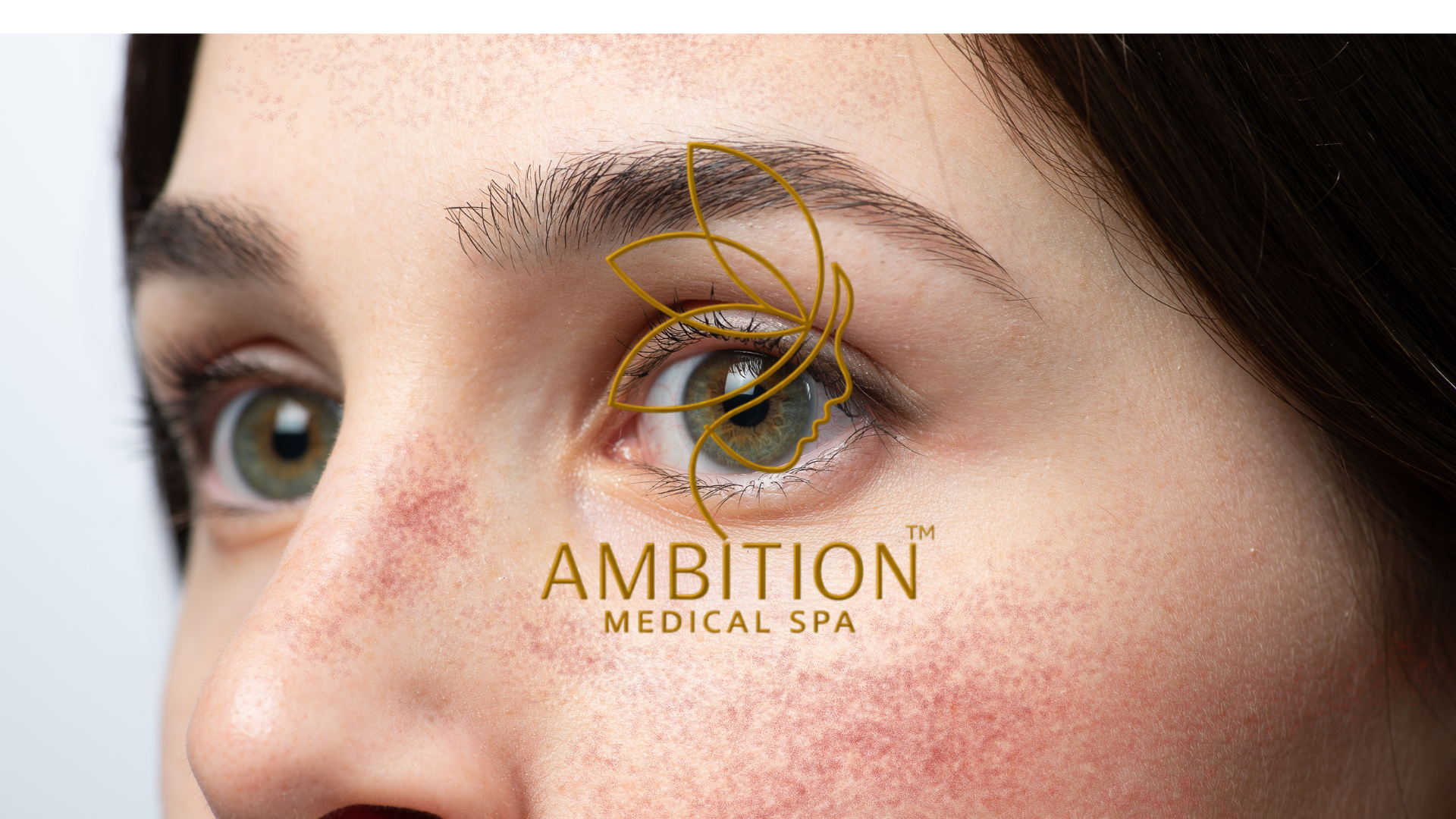 Rosacea facial redness with visible blood vessels on cheeks, treated at Ambition Medical Spa Rosacea facial redness with visible blood vessels on cheeks, treated at Ambition Medical Spa