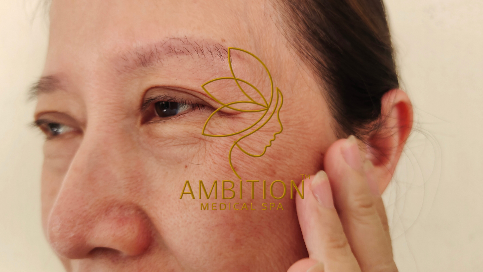 Wrinkles and fine lines on face showing signs of aging, improved with professional anti-aging treatments at Ambition Medical Spa