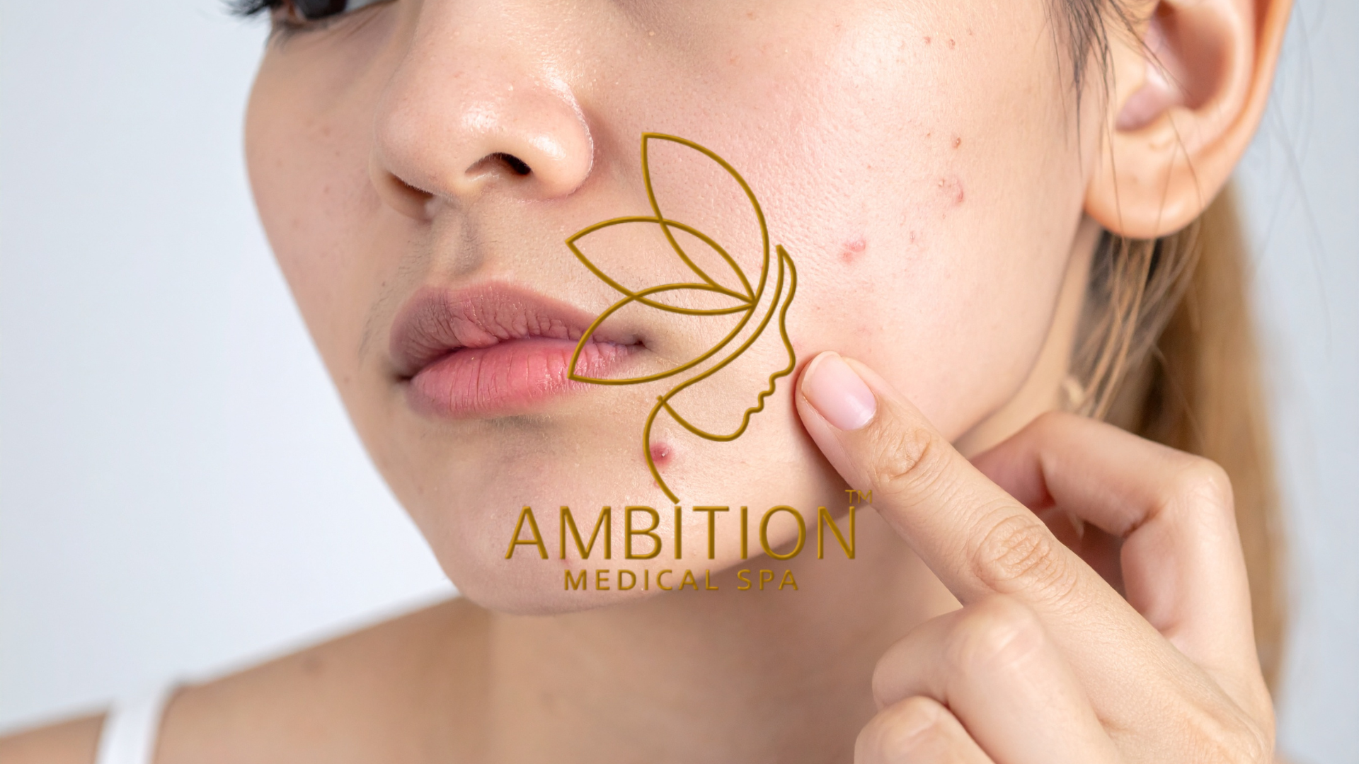 Acne-prone skin with pimples, blackheads, and inflammation, treated with professional acne solutions at Ambition Medical Spa