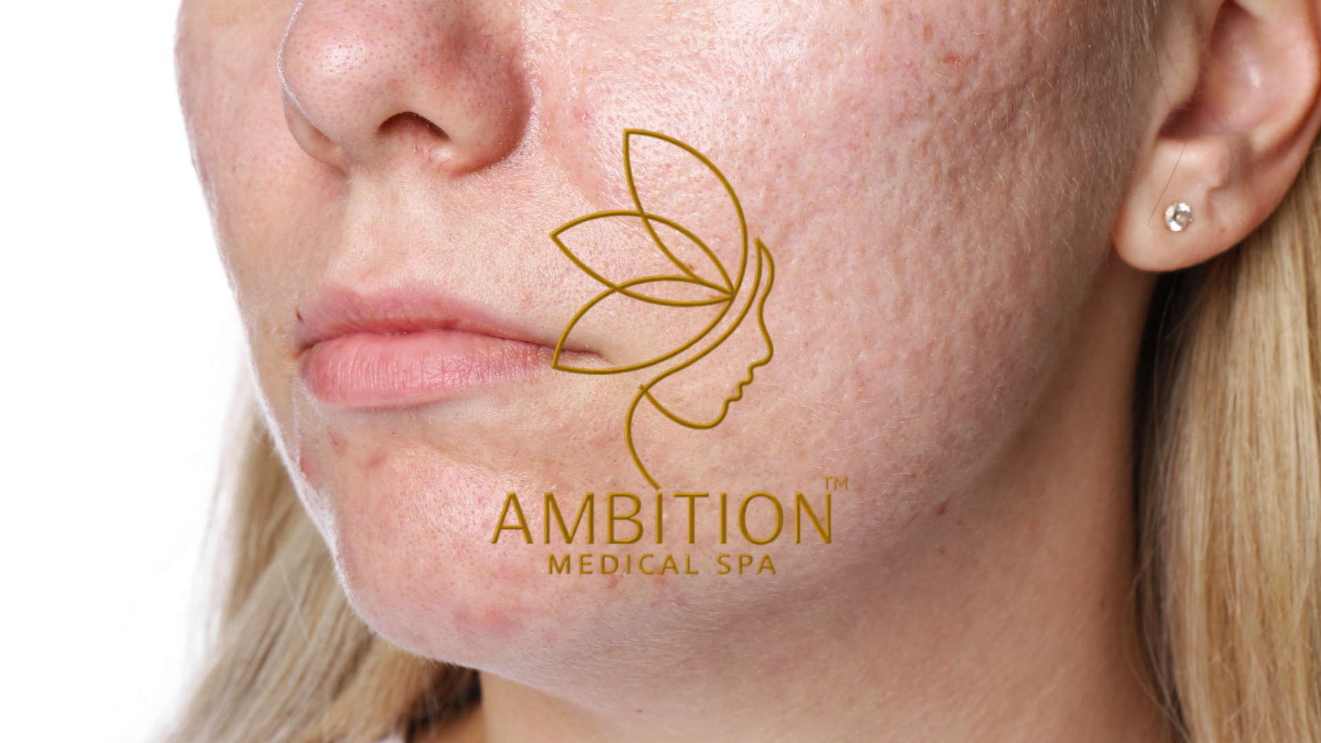 Enlarged facial pores with uneven skin texture, minimized and refined with professional treatments at Ambition Medical Spa