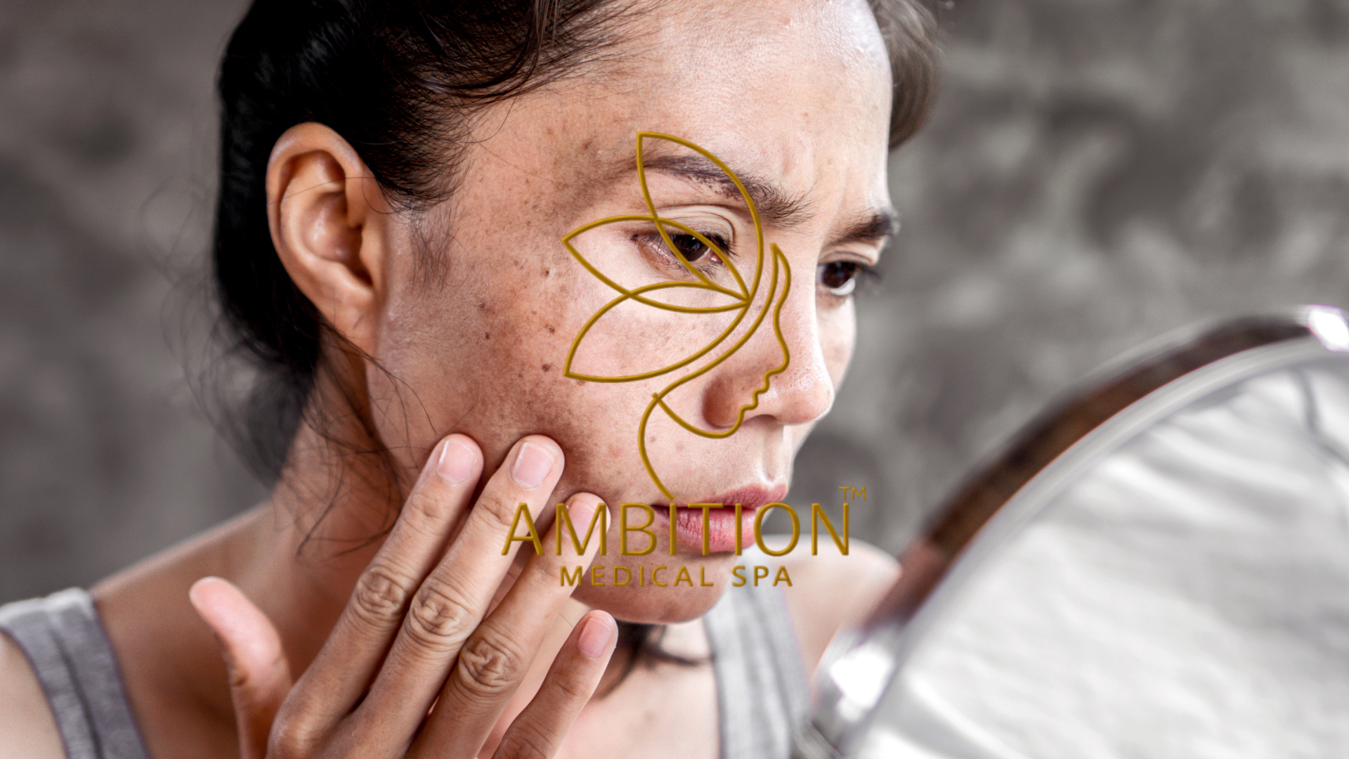 Hyperpigmentation with dark spots and uneven skin tone, treated with professional brightening and corrective treatments at Ambition Medical Spa