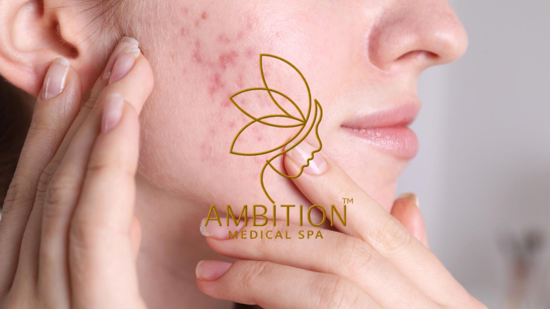 Acne-prone skin with pimples, blackheads, and inflammation, treated with professional acne solutions at Ambition Medical Spa Acne-prone skin with pimples, blackheads, and inflammation, treated with professional acne solutions at Ambition Medical Spa