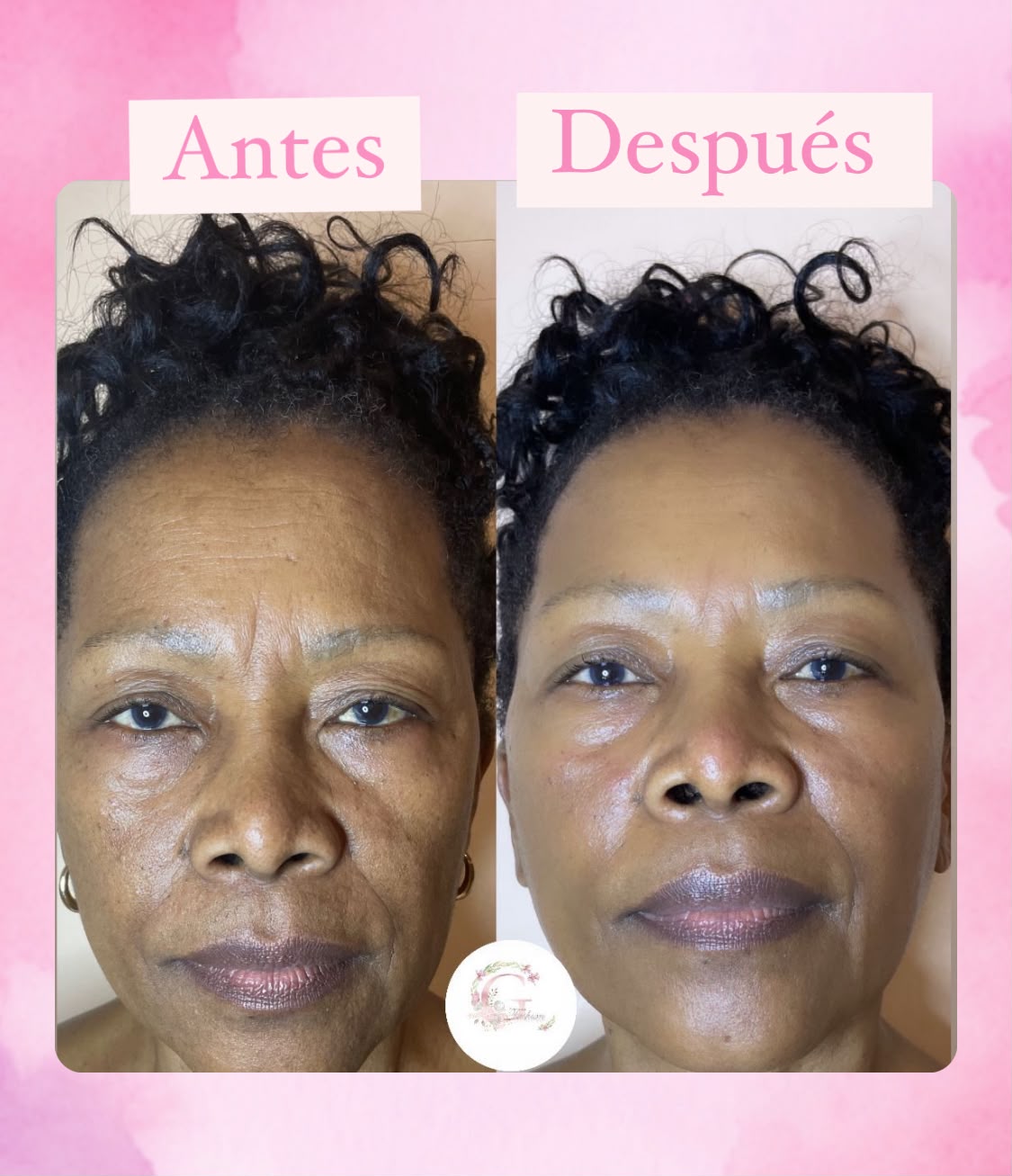 Resultado de tratamientos faciales 9