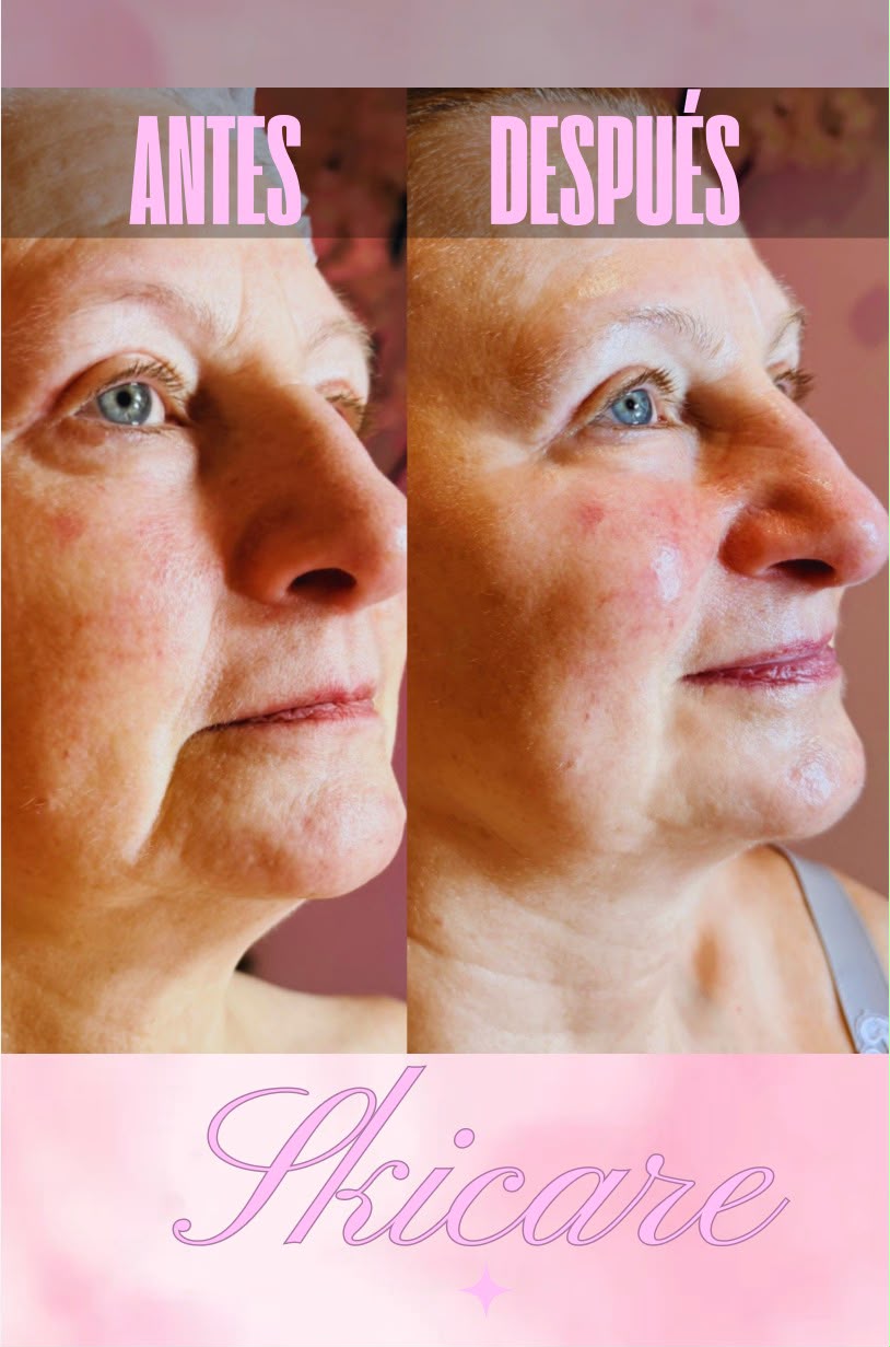 Resultado de tratamientos faciales 8