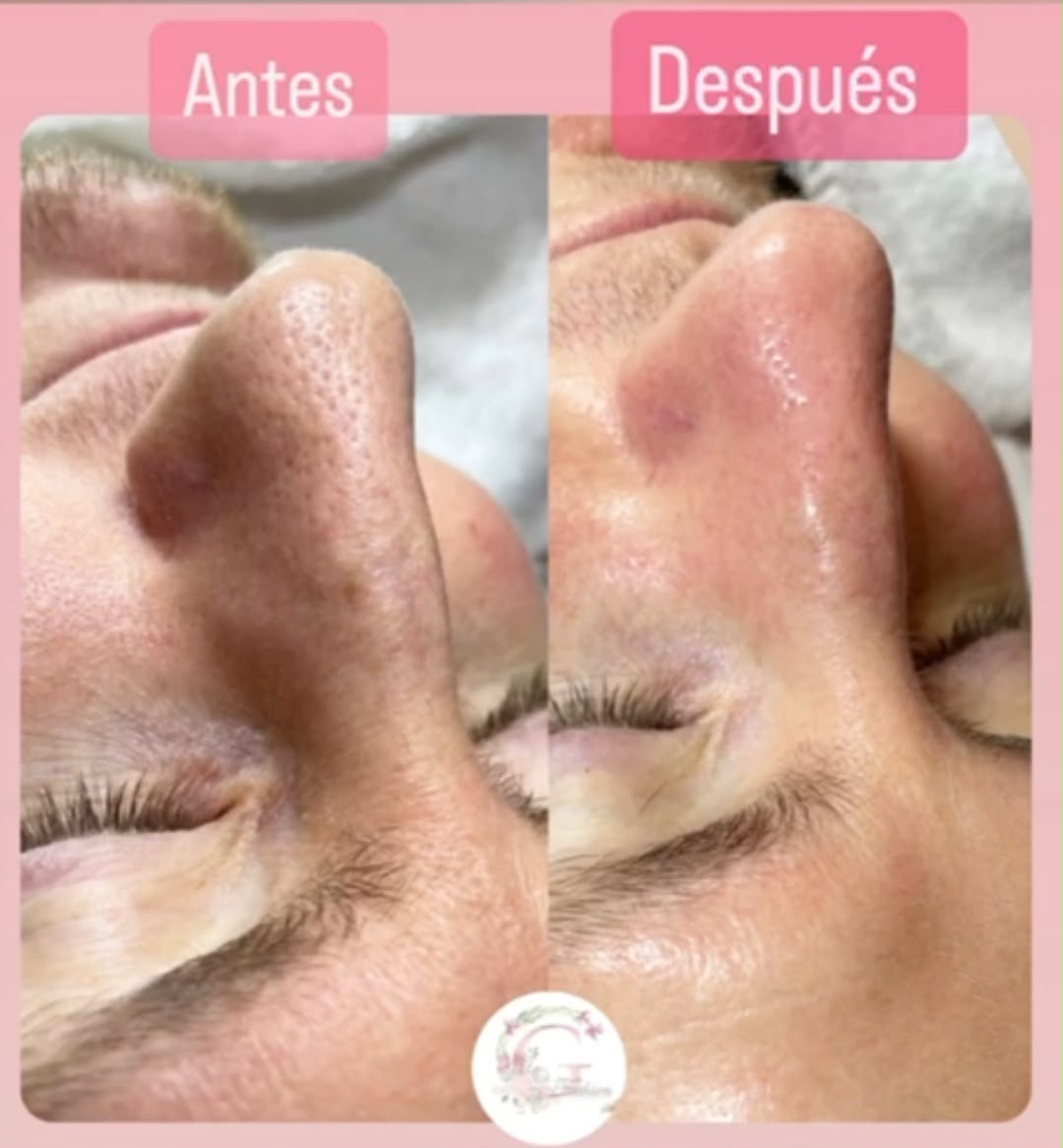 Resultado de tratamientos faciales 11