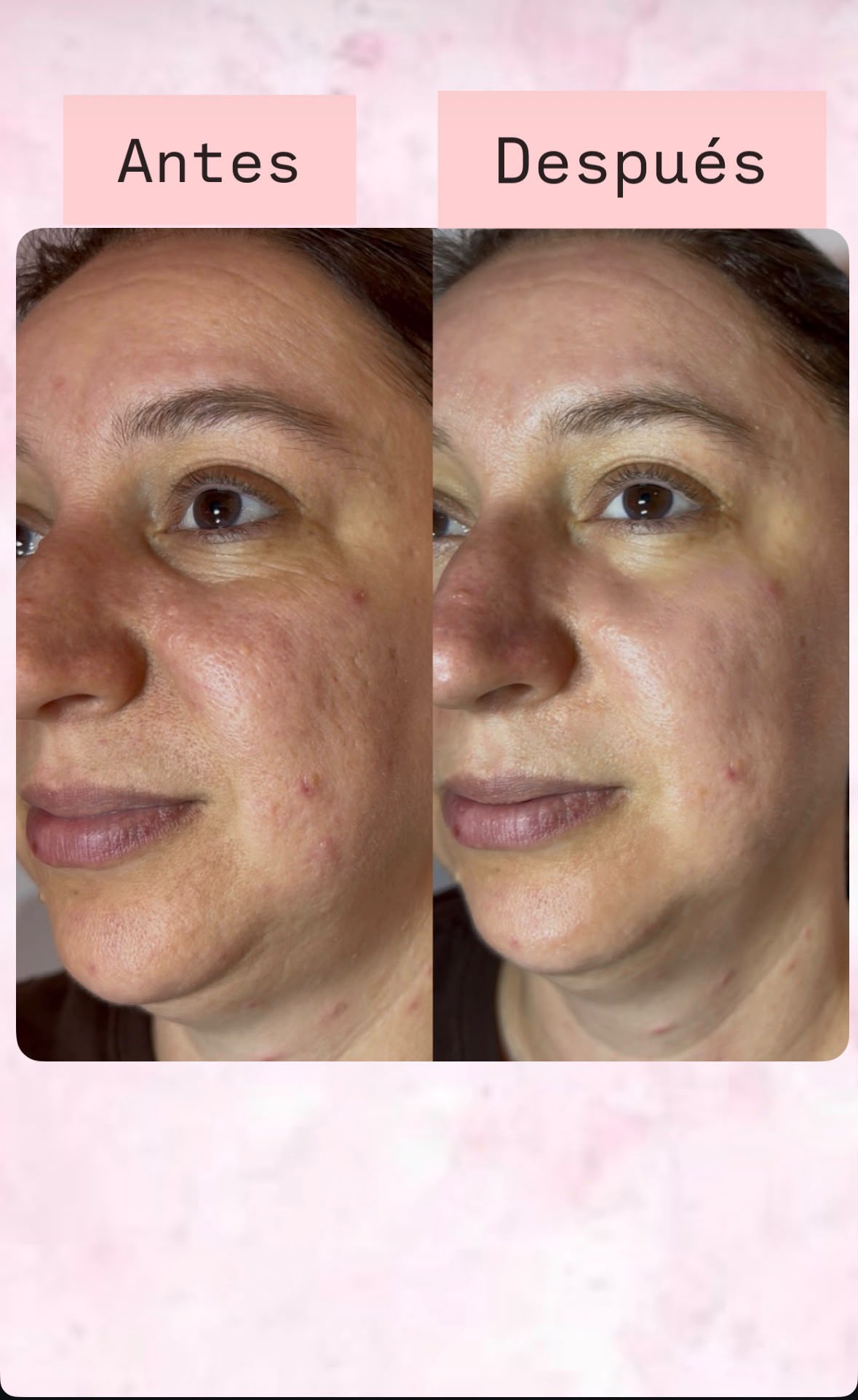 Resultado de tratamientos faciales 2