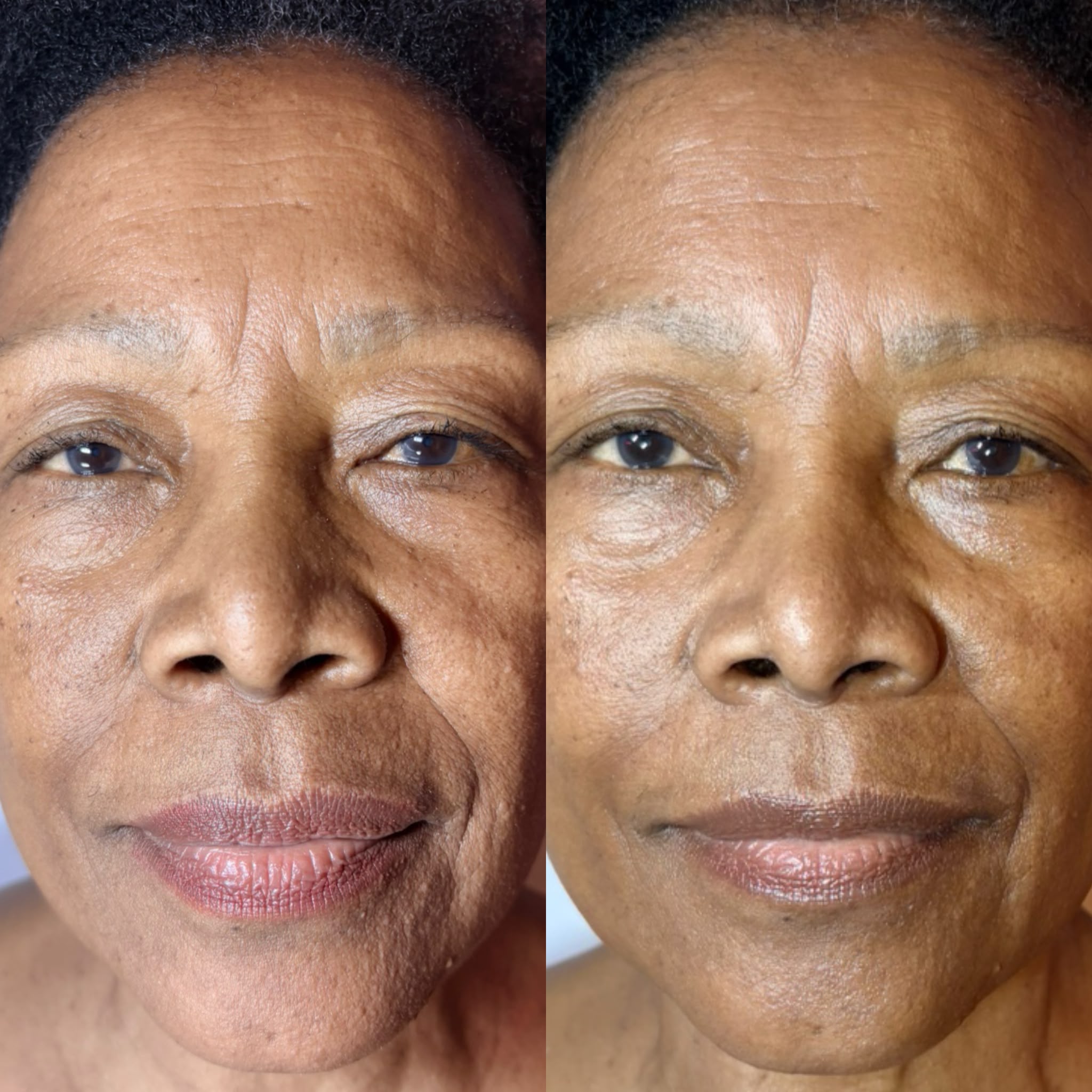Resultado de tratamientos faciales 6