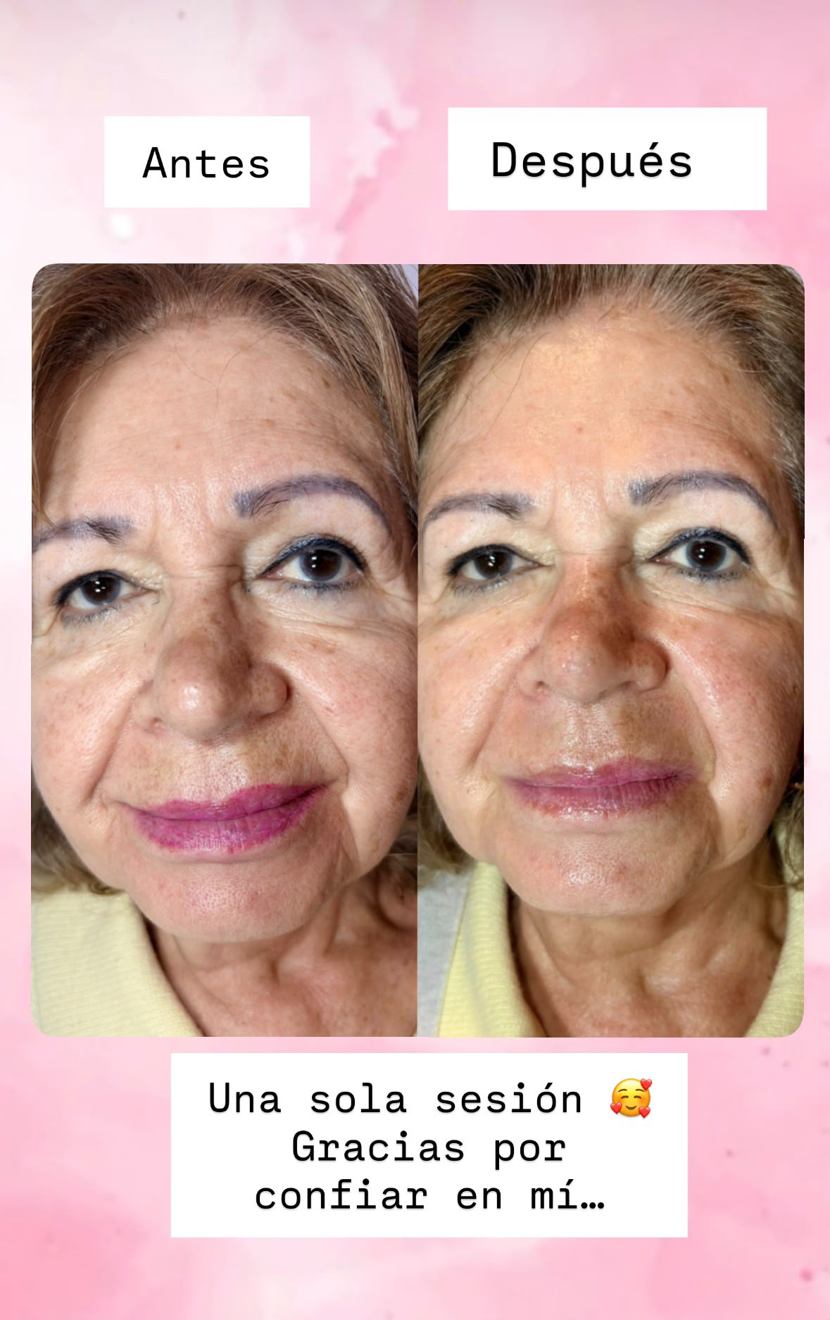 Resultado de tratamientos faciales 5