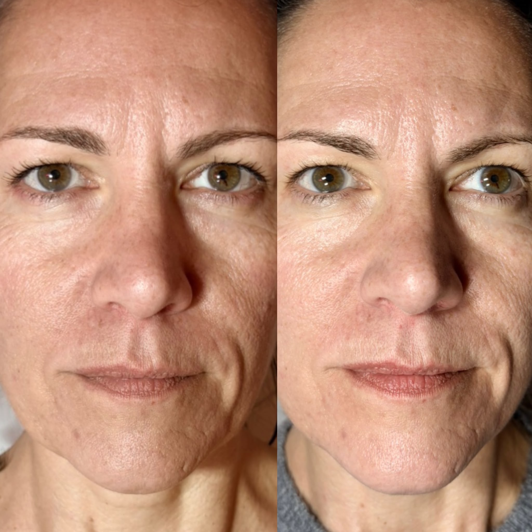 Resultado de tratamientos faciales 4