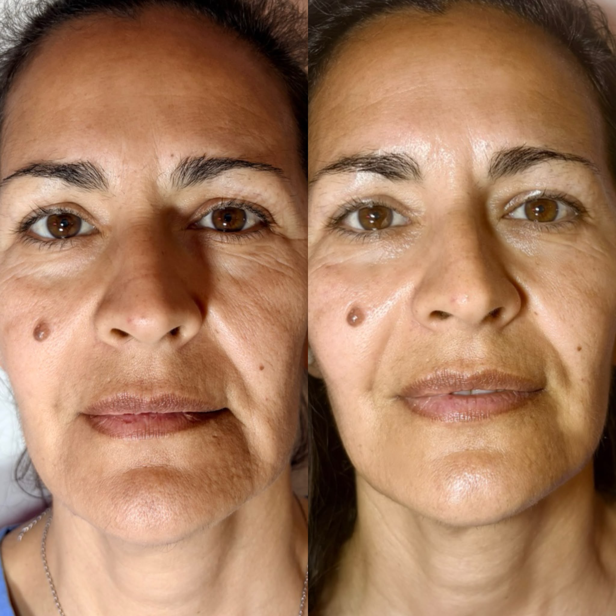 Resultado de tratamientos faciales 3