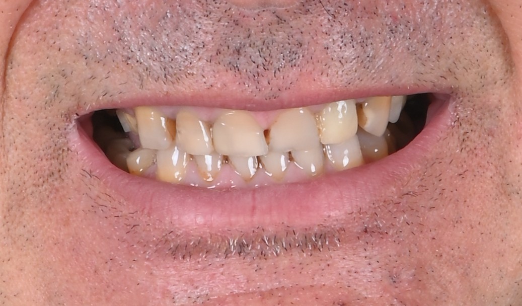 Antes carillas dentales cliente 1