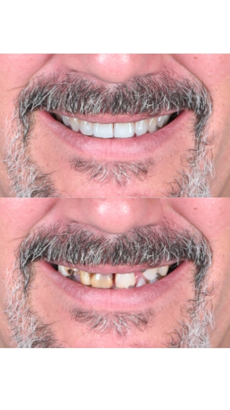 Antes y después carillas dentales cliente 2