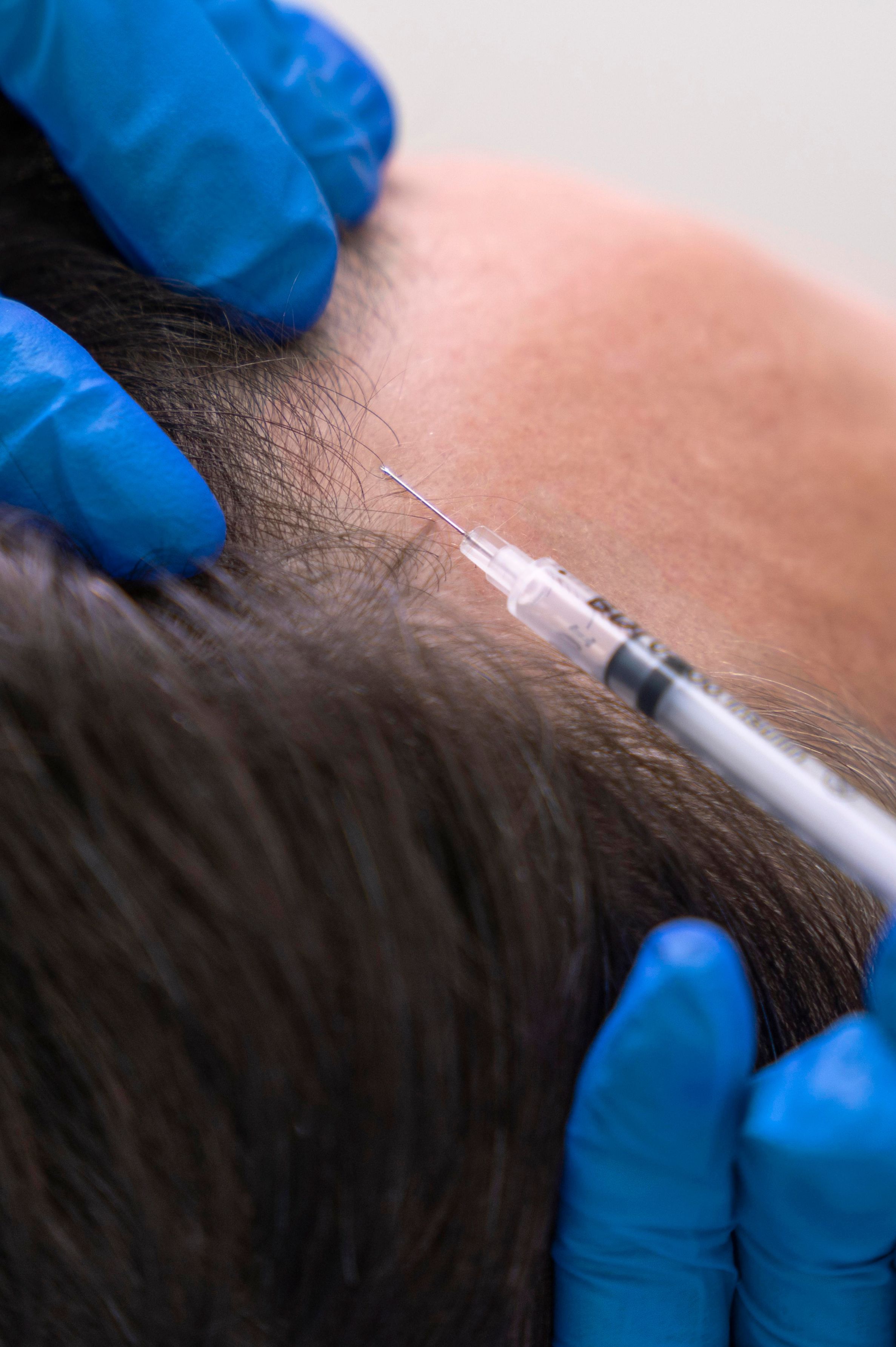 Natural hair regrowth treatment in Marthandam