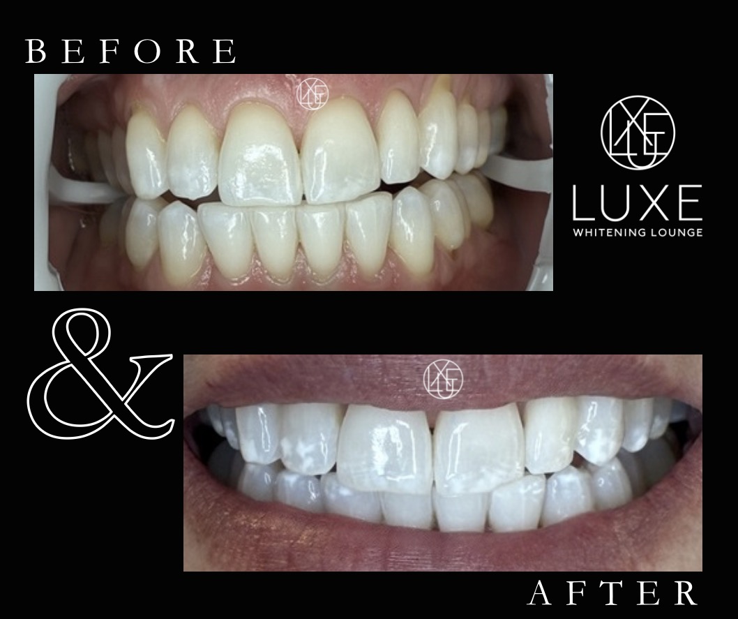 Teeth whitening before and after 5 at LUXE Whitening Lounge Reno