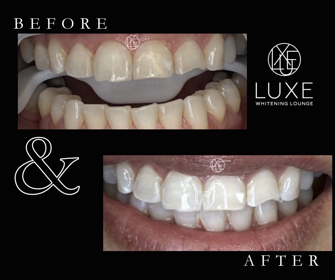 Teeth whitening before and after 6 at LUXE Whitening Lounge Reno