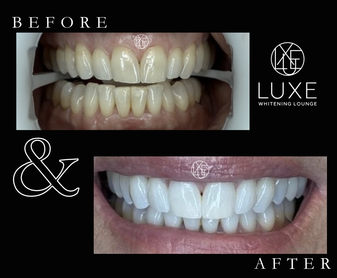 Teeth whitening before and after 3 at LUXE Whitening Lounge Reno
