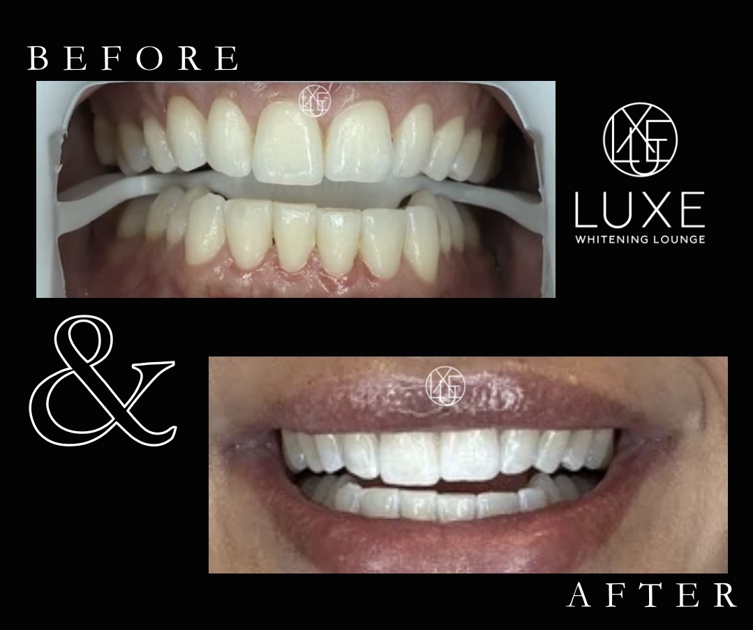 Teeth whitening before and after 4 at LUXE Whitening Lounge Reno