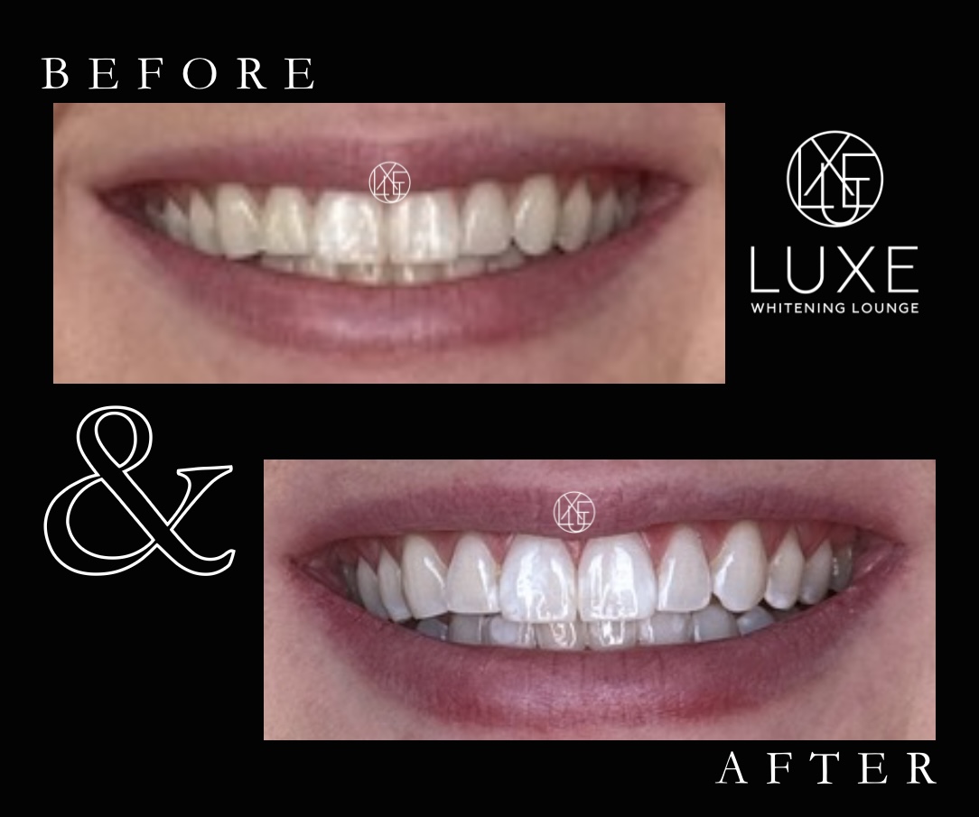 Teeth whitening before and after 2 at LUXE Whitening Lounge Reno