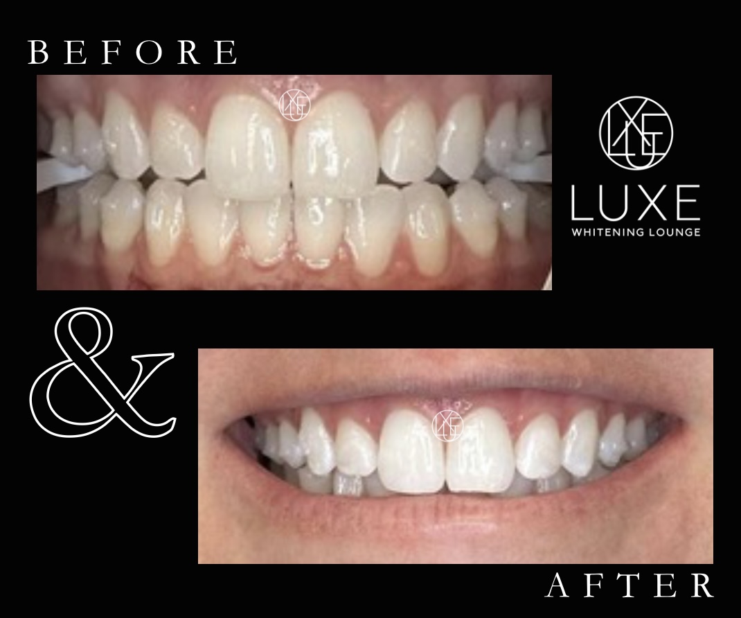 Teeth whitening before and after 1 at LUXE Whitening Lounge Reno