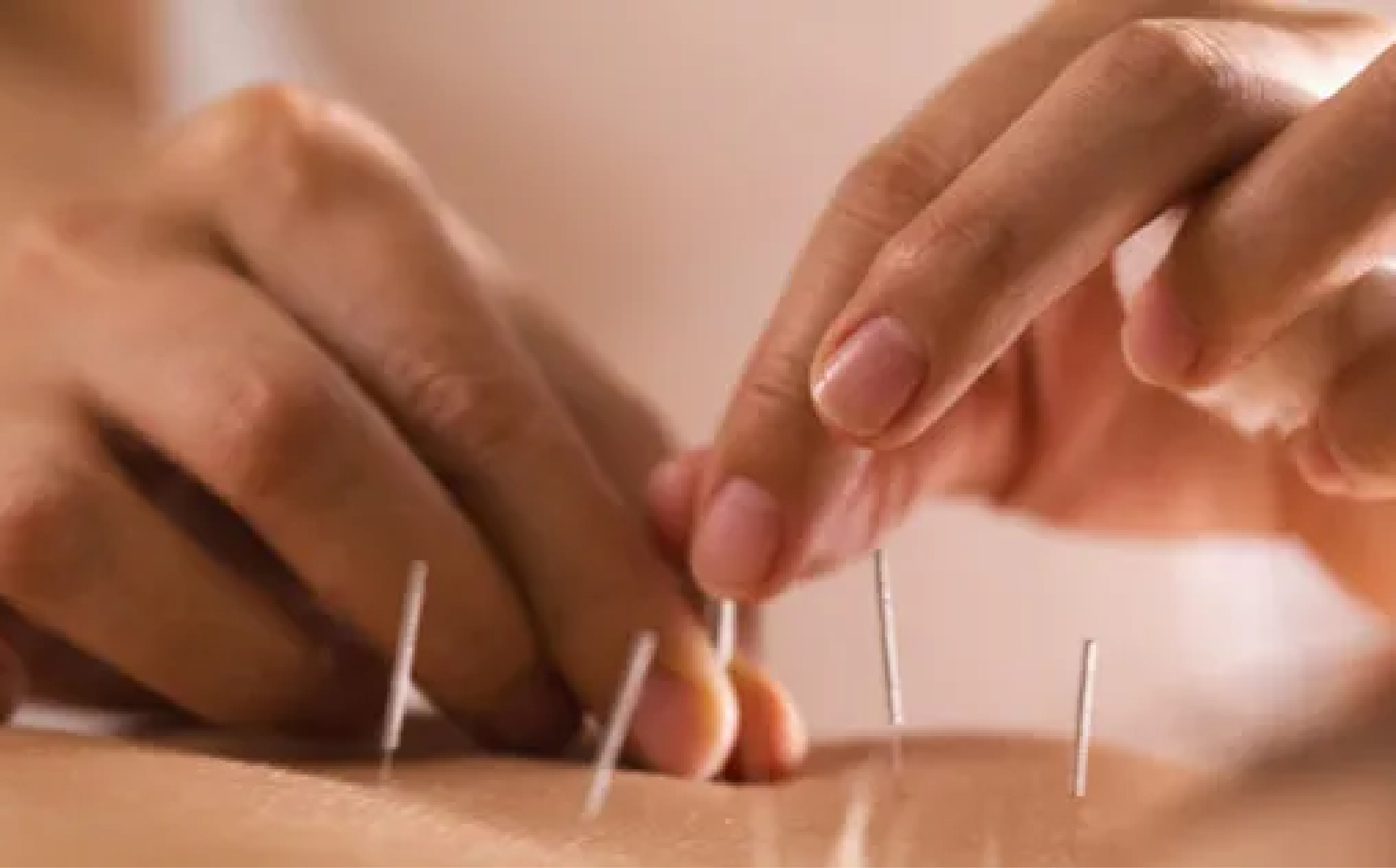 Acupuncture
