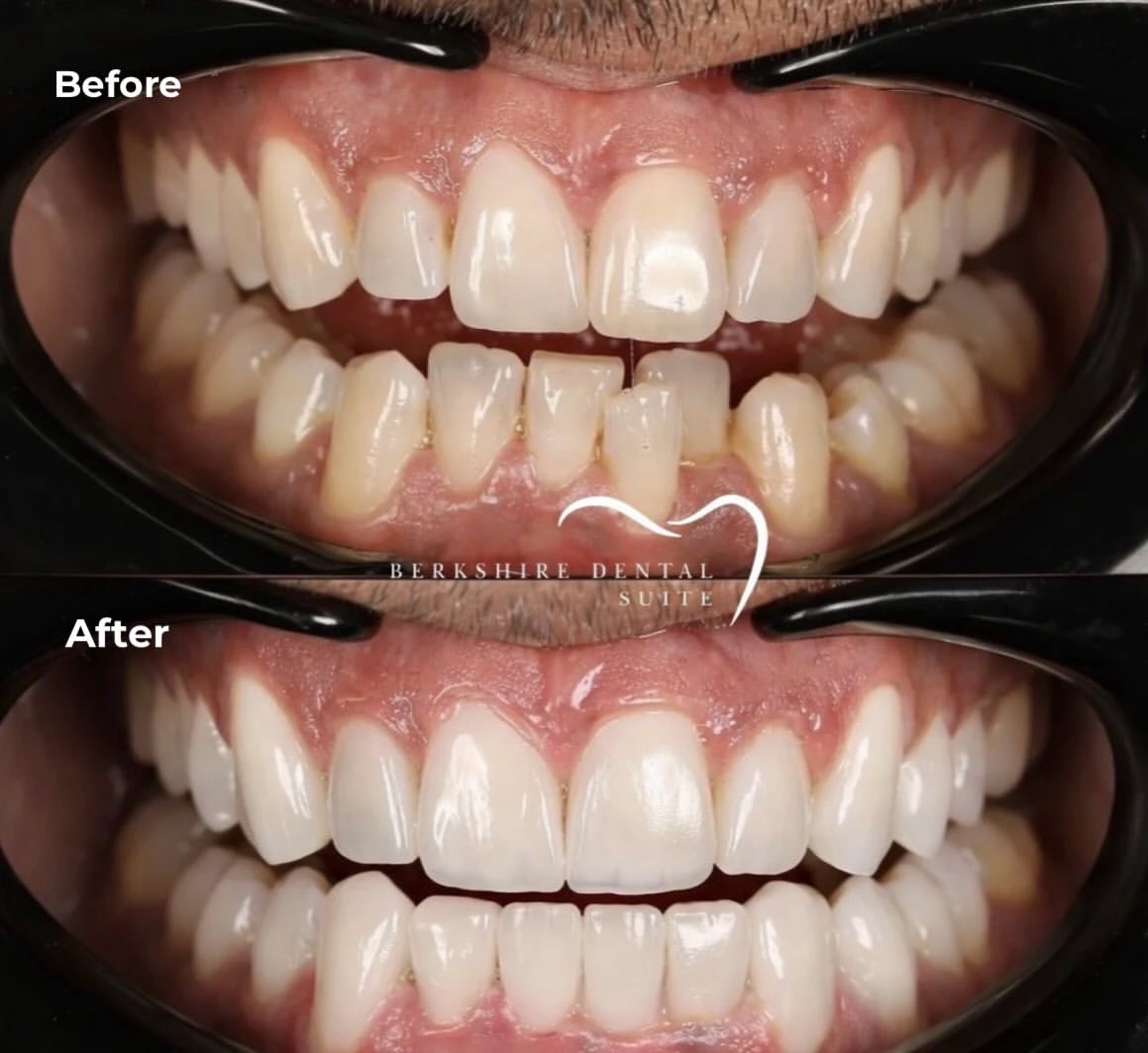 Composite bonding result 2