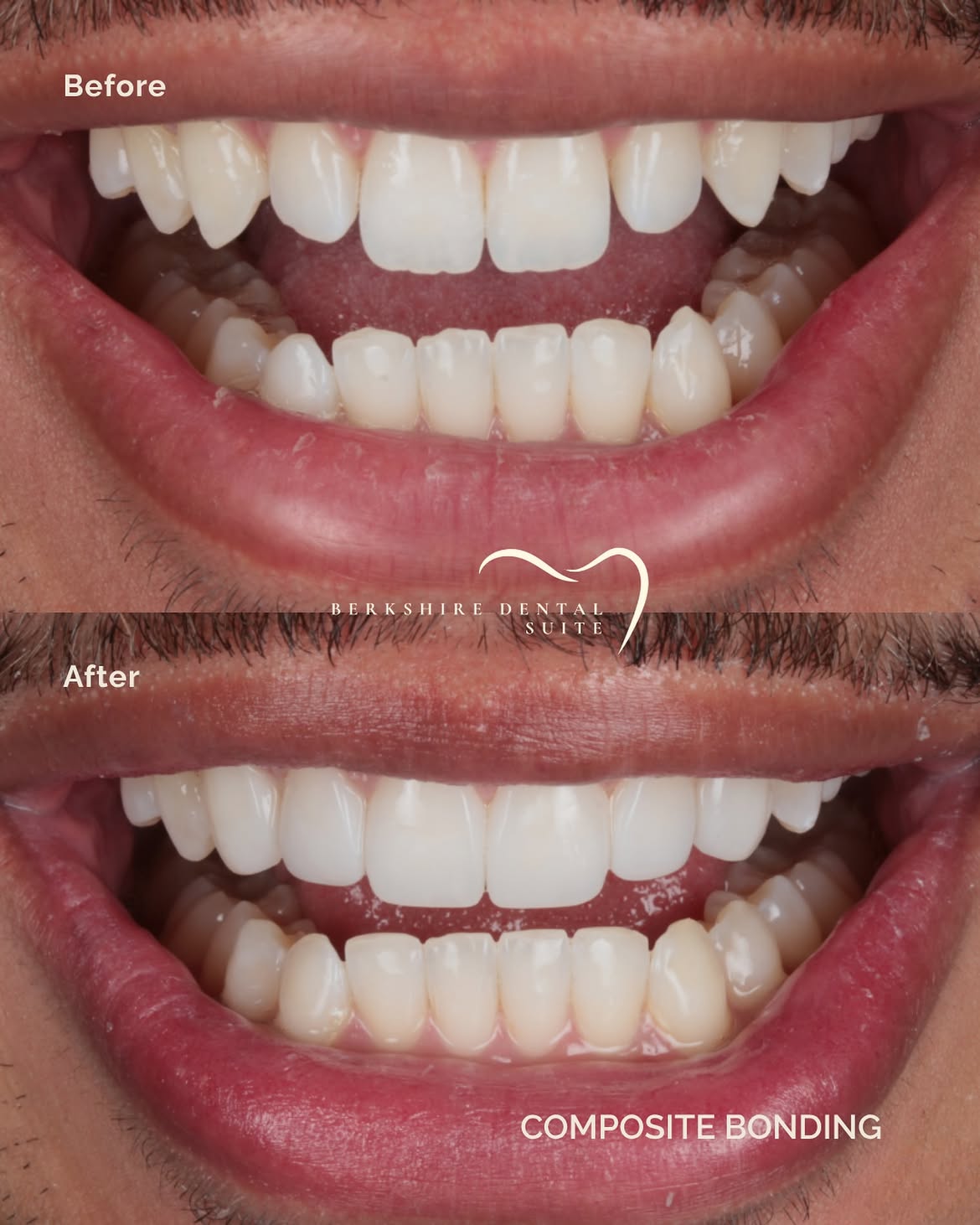 Composite bonding result 3