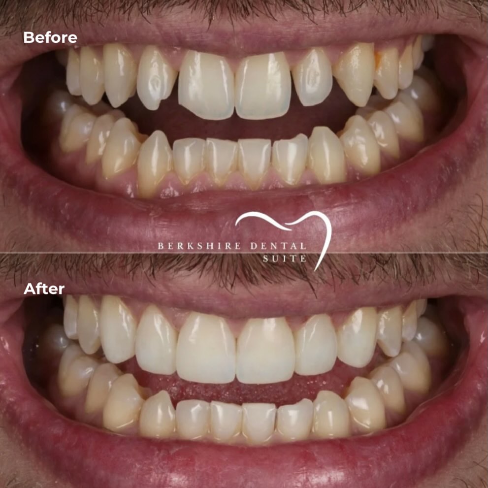 Composite bonding result 5