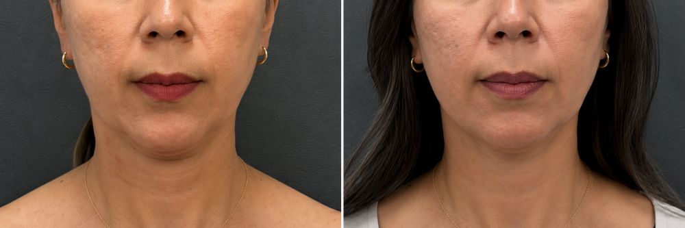 Antes y después de lifting facial sin cirugía, caso 4