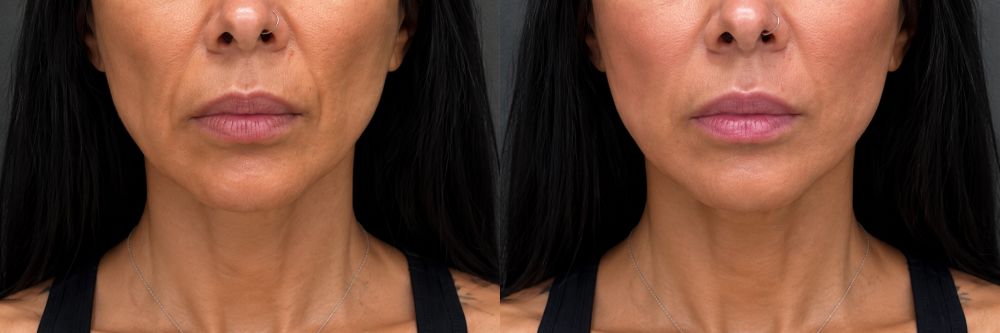 Antes y después de lifting facial sin cirugía, caso 2